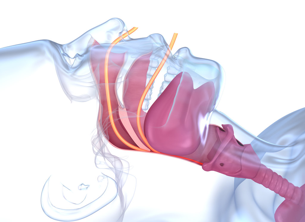Sleep apnea syndrome. Labeled nasal tongue blocked airway, 3D animation