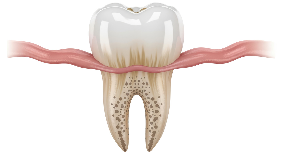 Isolated molar tooth with cavities and gumline infection, dental health illustration